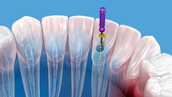 Leczenie kanałowe w Polsce vs USA — porównanie kosztów endodoncji w Białymstoku w 2026 roku